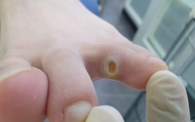 발가락 사이의 찌릿한 통증! 깊은굳은살과 티눈은 뿌리 뽑는 게 정답일까? (ft. 풋스올영등포당산점)